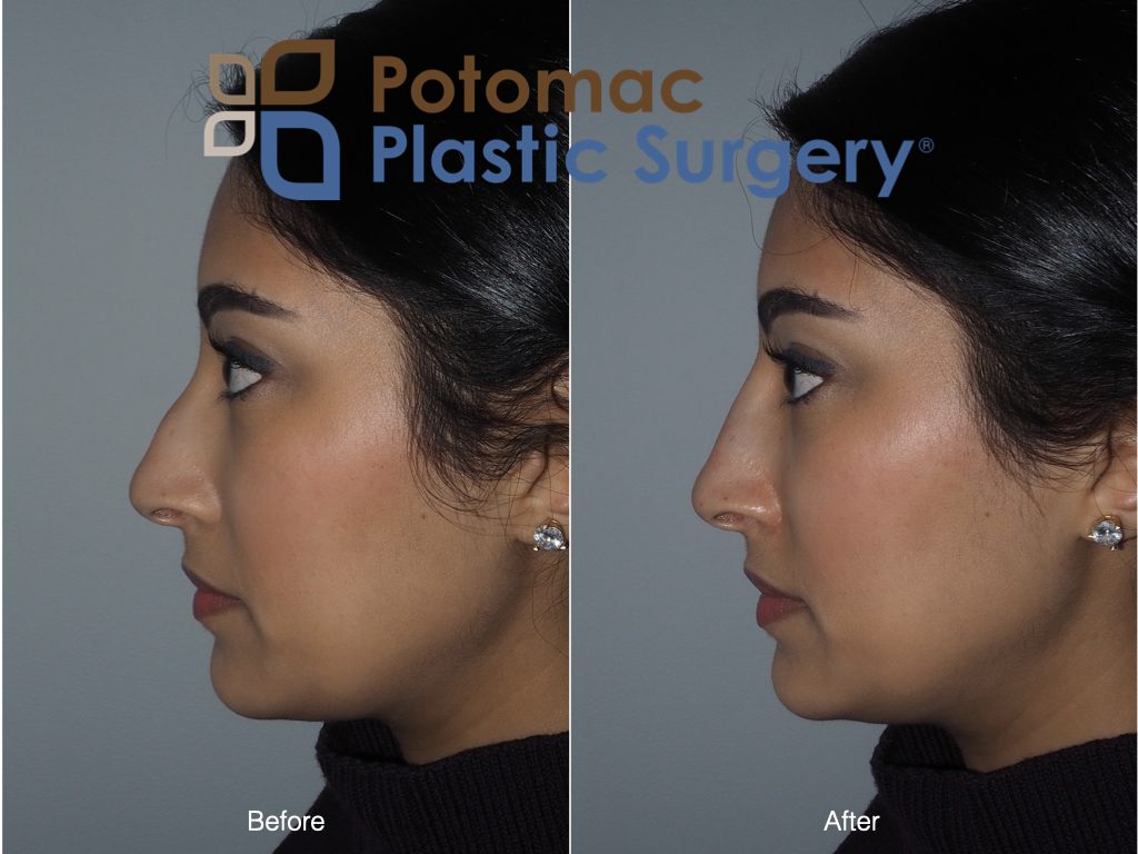 liquid nose job filler injection