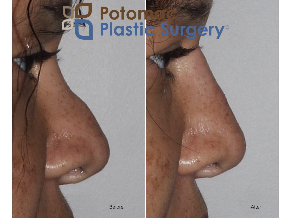 liquid nose job filler injection