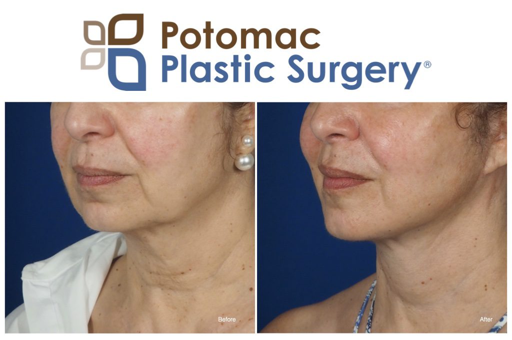 facelift neck lift liposuction smas deep plane