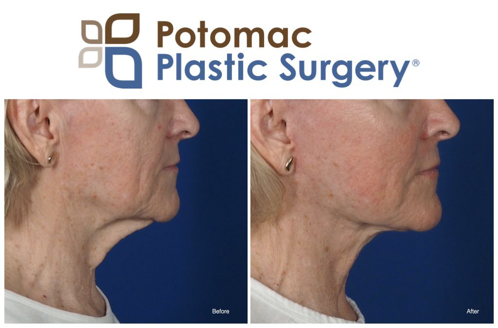 Deep Plane Facelift, Neck Lift