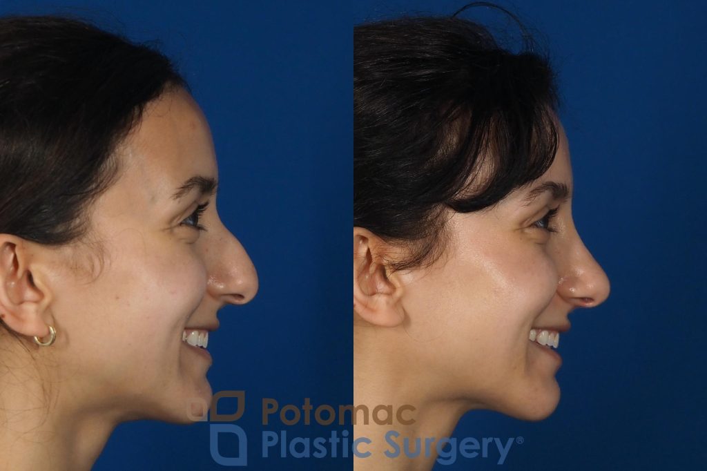 bump,hump,nose,nose surgery,plastic surgery,profile,rhinoplasty,side view