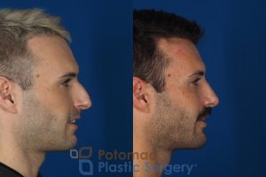 bump,hump,nose,nose surgery,plastic surgery,profile,rhinoplasty,side view