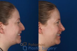 bump,hump,nose,nose surgery,plastic surgery,profile,rhinoplasty,side view