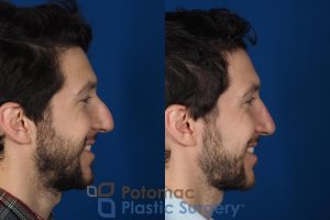 bump,hump,nose,nose surgery,plastic surgery,profile,rhinoplasty,side view