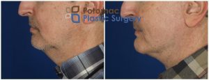 double chin, facelift, facial sculpting, liposuction, neck, neck fat, neck lift, plastic surgery, weak chin