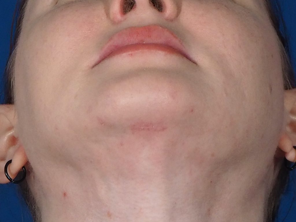 Deep Neck Lift Surgery