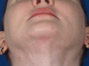 Deep neck lift surgery scar