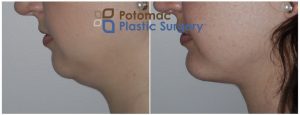 double chin, facial sculpting, liposuction, neck, neck fat, neck lift, plastic surgery, weak chin