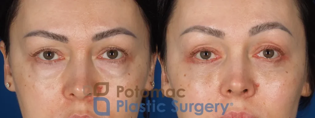 Lower blepharoplasty and fat transfer